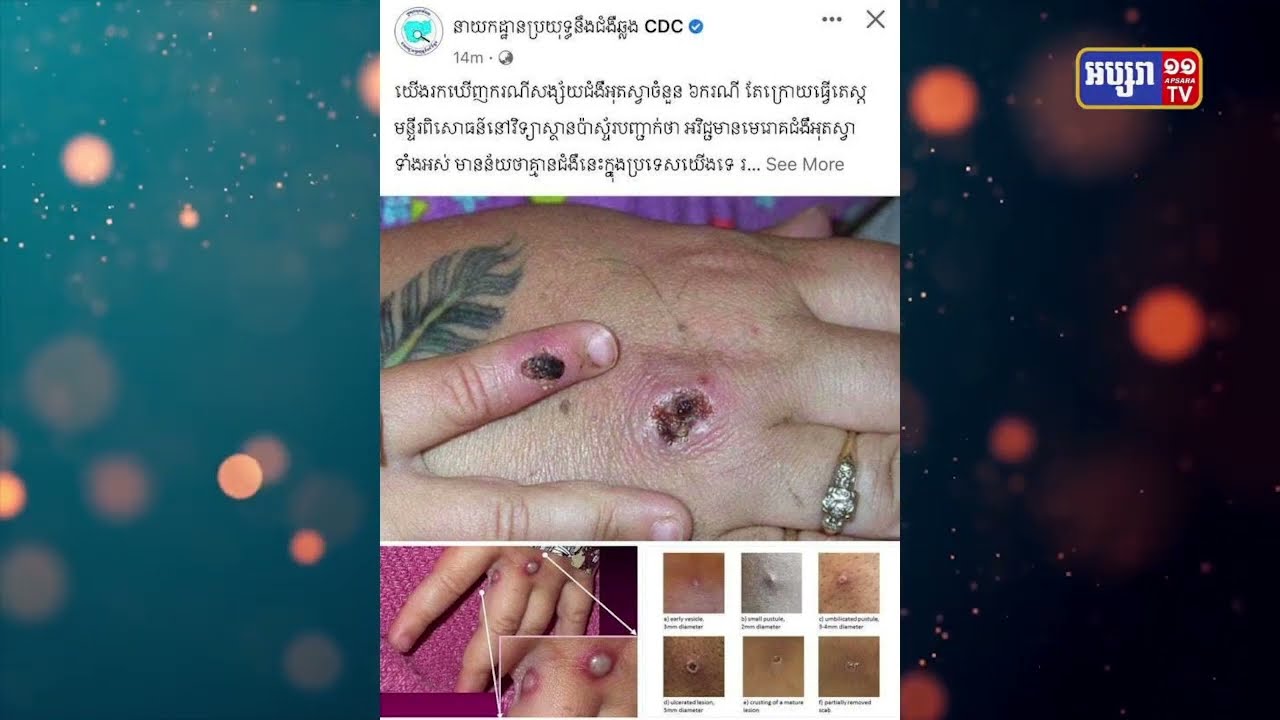 កម្ពុជាធ្វើតេស្តលើមនុស្ស៦នាក់លើកដំបូងរកវីរុសអុតស្វា (Video Inside)