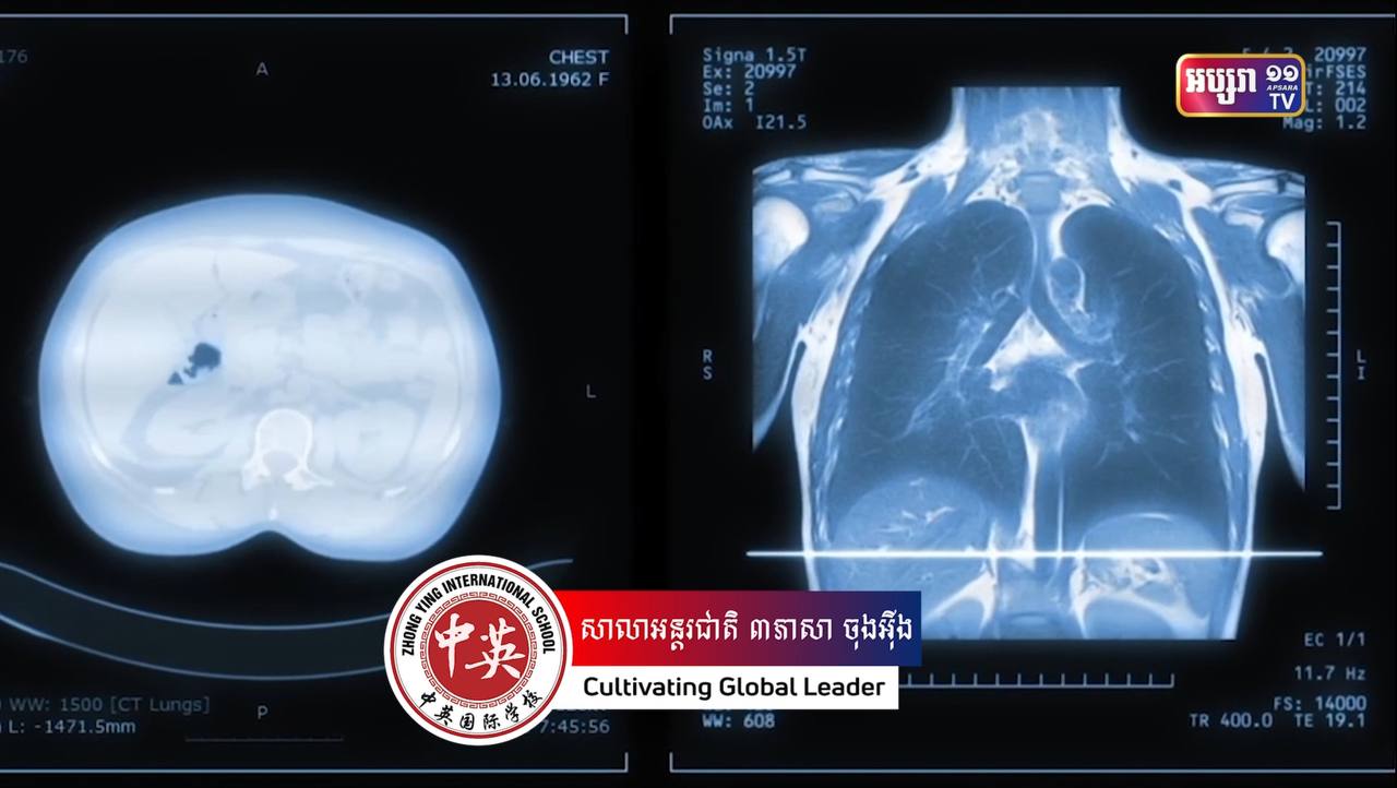 ការសិក្សារកឃើញថា ដុំប្លាស្ទិកតូចៗកំពុងជ្រៀតចូលខួរក្បាលរបស់មនុស្ស